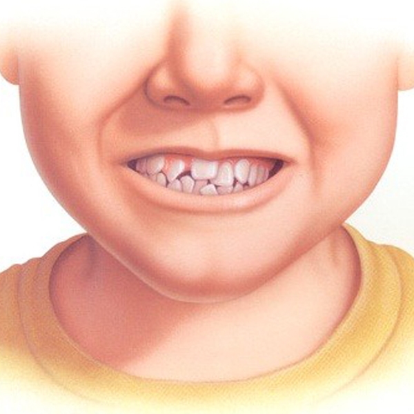 Chỉnh Hình Răng - Mặt (CHRM)