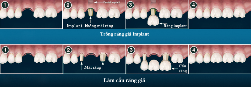 Trồng răng giả implant 03