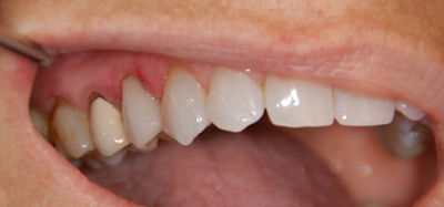 lợi ích trồng răng giả implant 02