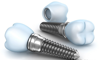 lợi ích trồng răng giả implant