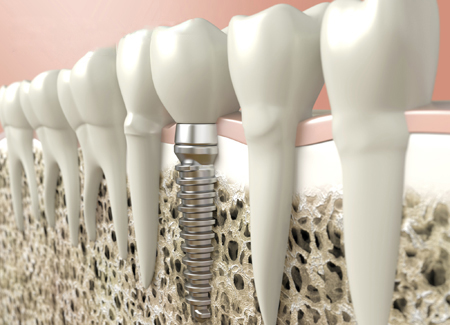 lợi ích trồng răng giả implant03