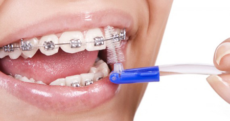 Hướng dẫn vệ sinh răng miệng khi đang niềng răng