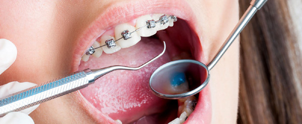 niềng răng điều trị khớp thái dương hàm