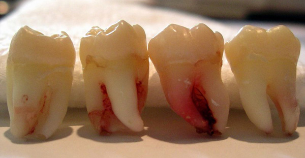 Tìm hiểu về răng số 8 (răng khôn)