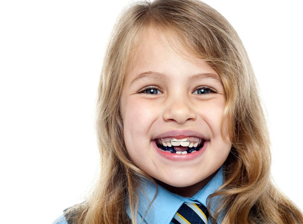 Nếu răng mọc sai lệch, tại sao chúng ta cần niềng răng sớm?