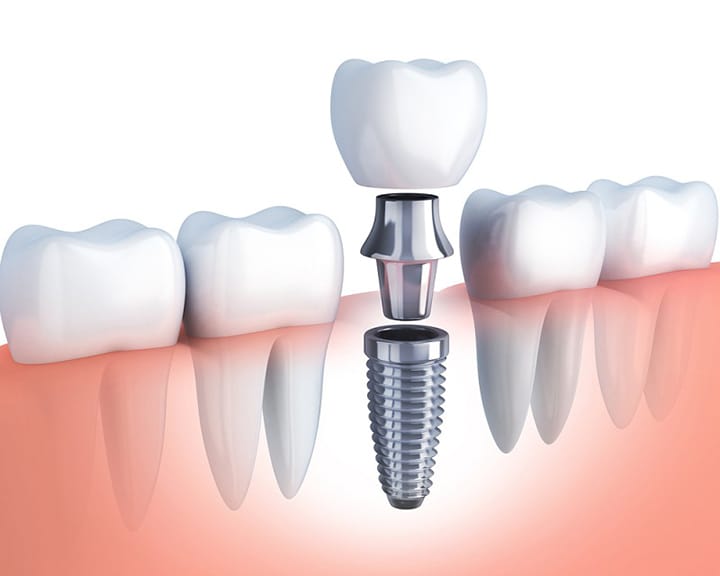 Trồng răng Implant thời đại 4.0 có gì mới?