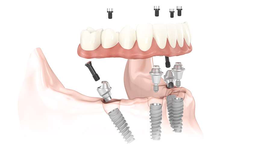 Công nghệ số nâng cao tỷ lệ thành công cấy ghép Implant