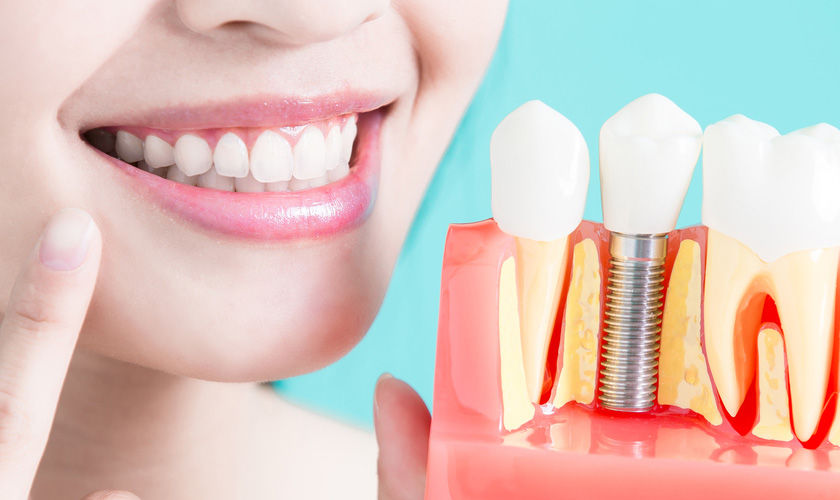 Phục hồi gai nướu trong Implant vùng thẩm mỹ