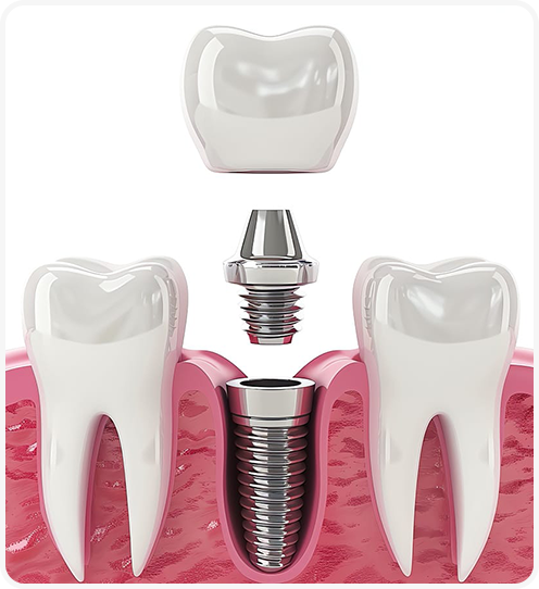 Tầm quan trọng của Implant cá nhân hóa trong nha khoa Việt Nam