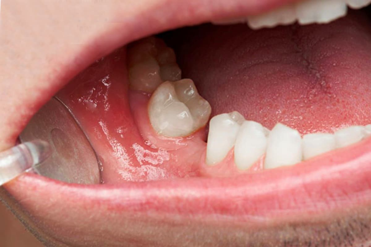 Mất răng có bị lệch mặt không? Nguy cơ & giải pháp khắc phục
