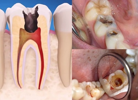 Bệnh lý tủy răng – Nguyên nhân và cách điều trị