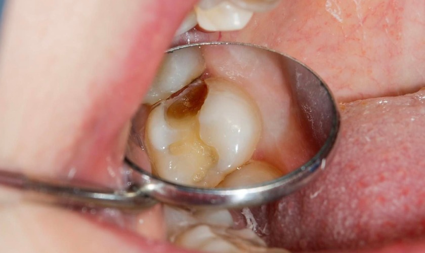 Nhận biết sớm dấu hiệu sâu răng đến tủy