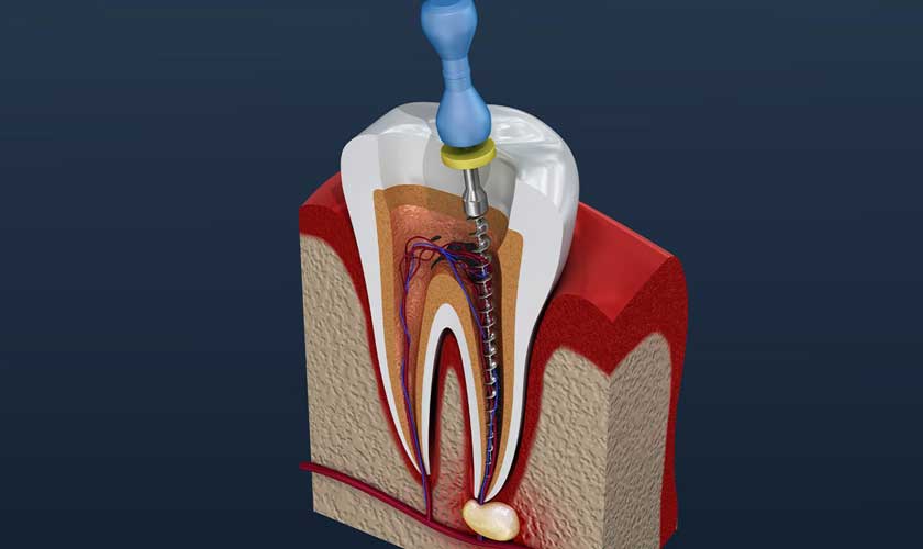 Cách lấy tủy răng đúng quy trình chuẩn