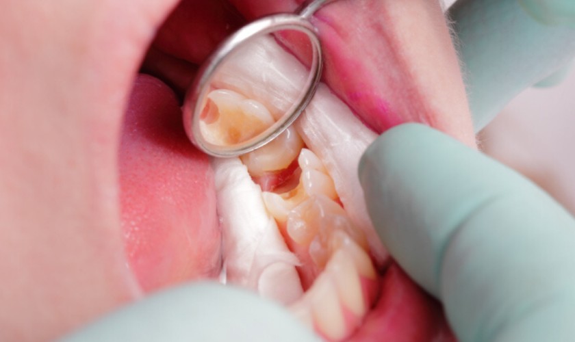 Những điều ba mẹ cần biết về điều trị tủy răng trẻ em