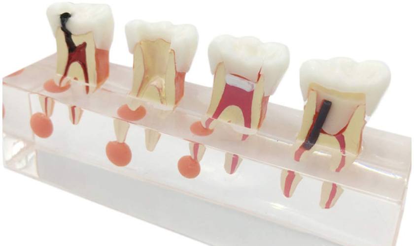 Những dấu hiệu viêm tủy răng không nên bỏ qua