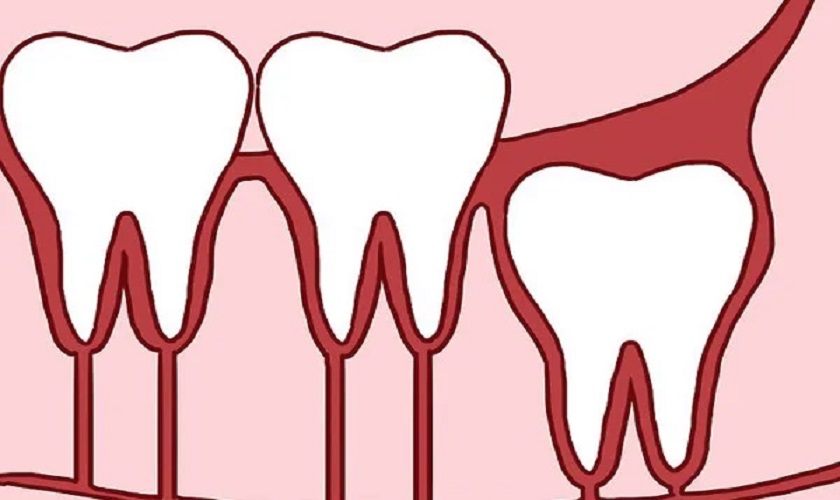 Nhổ răng khôn mọc thẳng có cần thiết không?