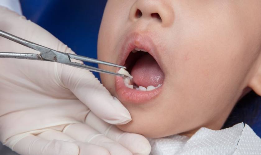 Nhổ răng trẻ em có đau không?