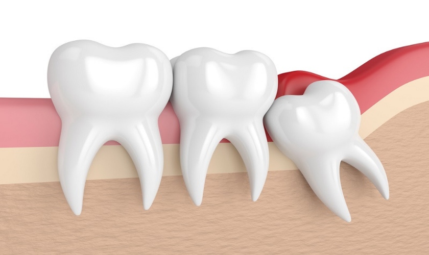 Nhổ răng khôn còn sót chân răng và cách khắc phục hiệu quả