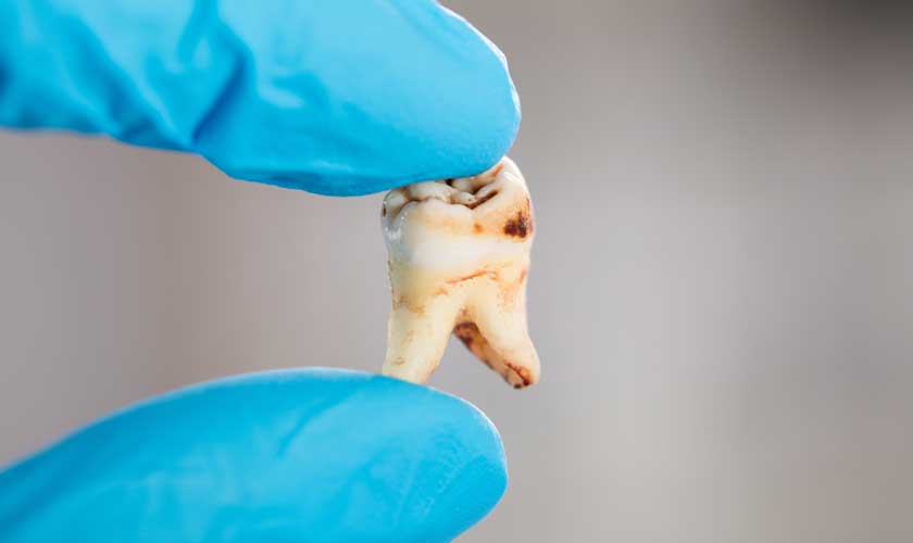 Sâu răng bị đau có nên nhổ không?
