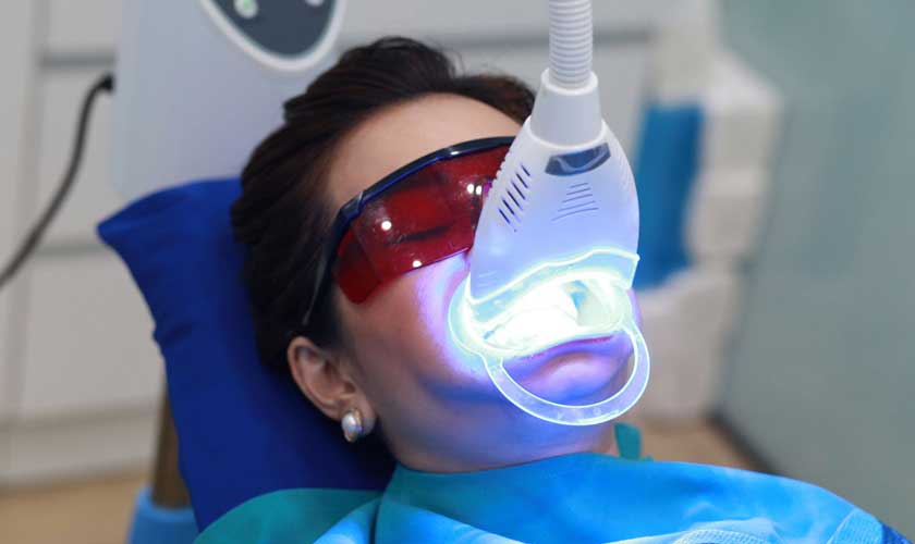 Những lợi ích khi tẩy trắng răng laser