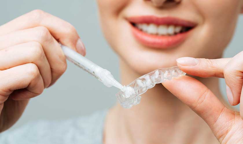 Những lưu ý khi tẩy trắng răng tại nhà bằng máng tẩy 