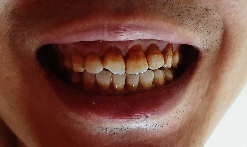 Răng ố vàng có tẩy trắng được không?