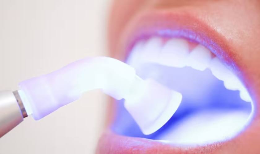 Phương pháp tẩy trắng răng cho hiệu quả tức thì