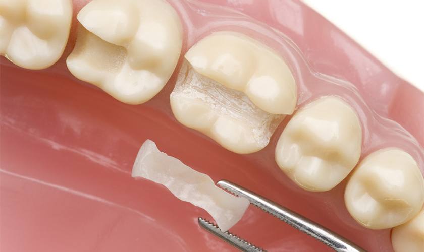 Hình ảnh trám răng và quy trình trám răng thẩm mỹ