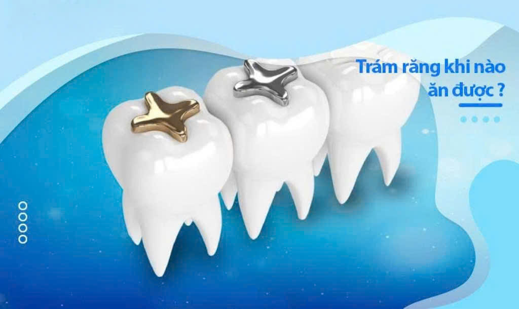 Trám răng khi nào ăn được? Lưu ý sau khi trám răng